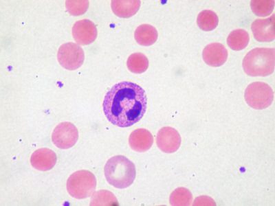 Anemia hemolítica autoinmune. Fuente: Flickr/ Ed Uthman