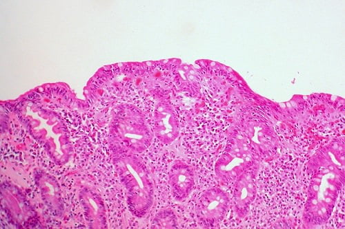 Biopsia intestinal de paciente con enfermedad celiaca. Fuente: Ed Uthman/Flickr 