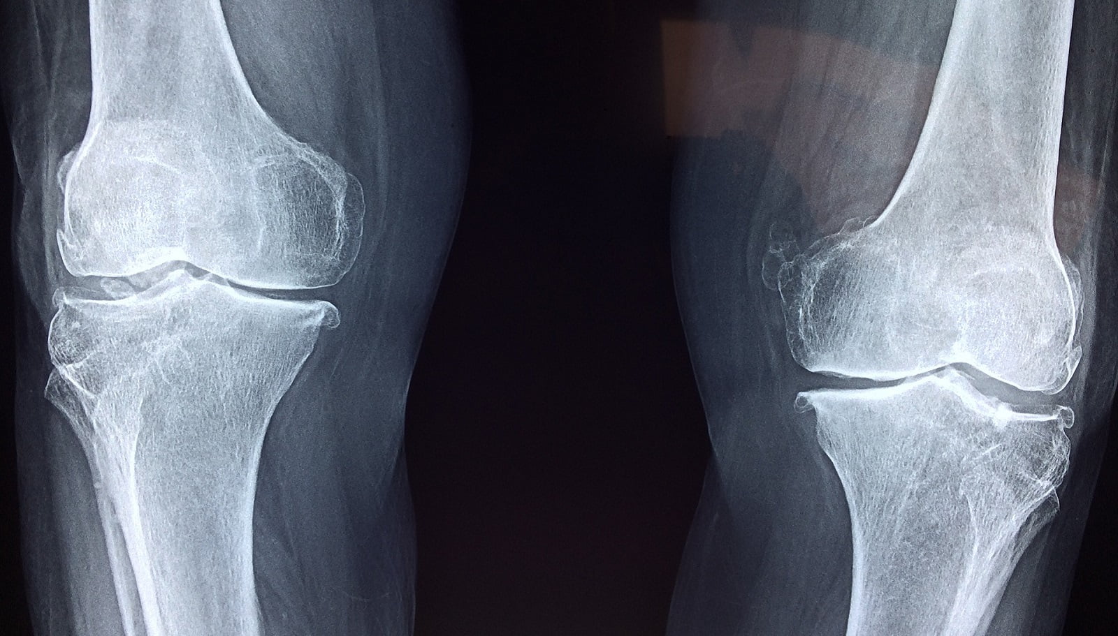 radiografía de rodilla